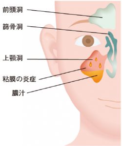 【画像】副鼻腔炎（蓄膿症）